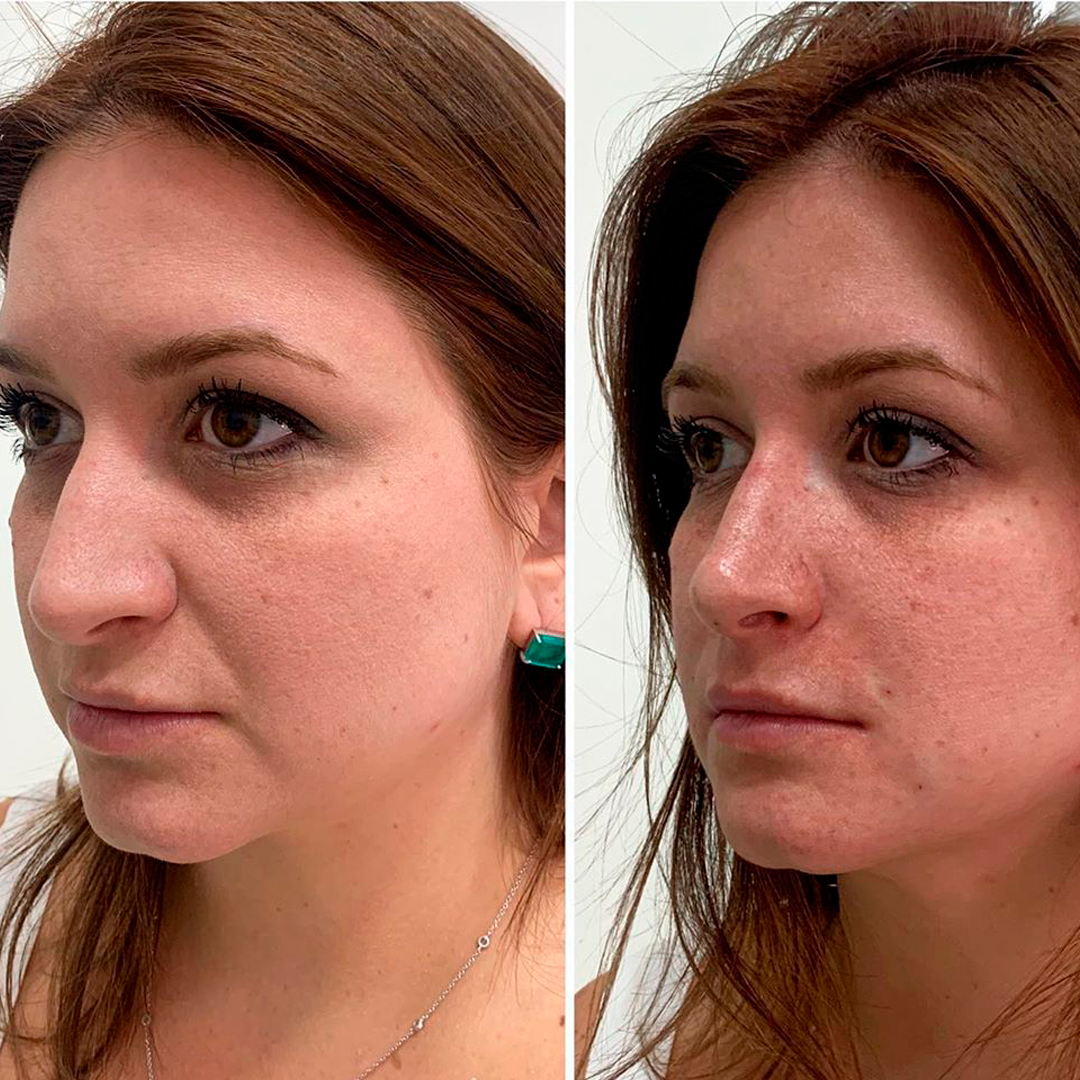before-after01